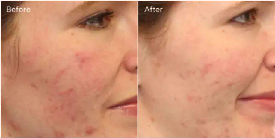 Clarifying Cleanser before and after