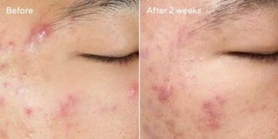 Deep Relief Blemish Treatment Murad-Skincare-before-and-after-600X300-1