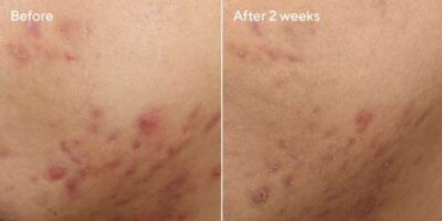 Deep Relief Blemish Treatment Murad-Skincare-before-and-after-600X300-2