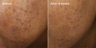 Deep Relief Blemish Treatment Murad-Skincare-before-and-after-600X300-3