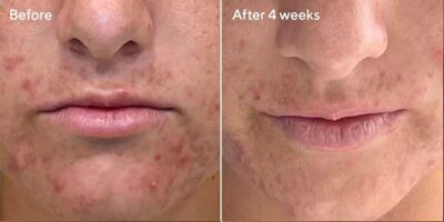 Deep Relief Blemish Treatment Murad-Skincare-before-and-after-4
