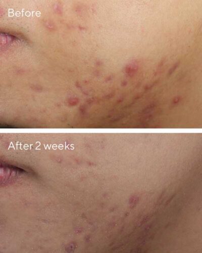 Deep Relief Blemish Treatment Murad-Skincare-before-and-after