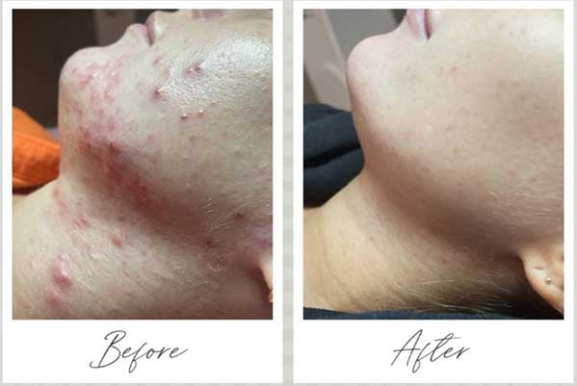 Dermalux before and after
