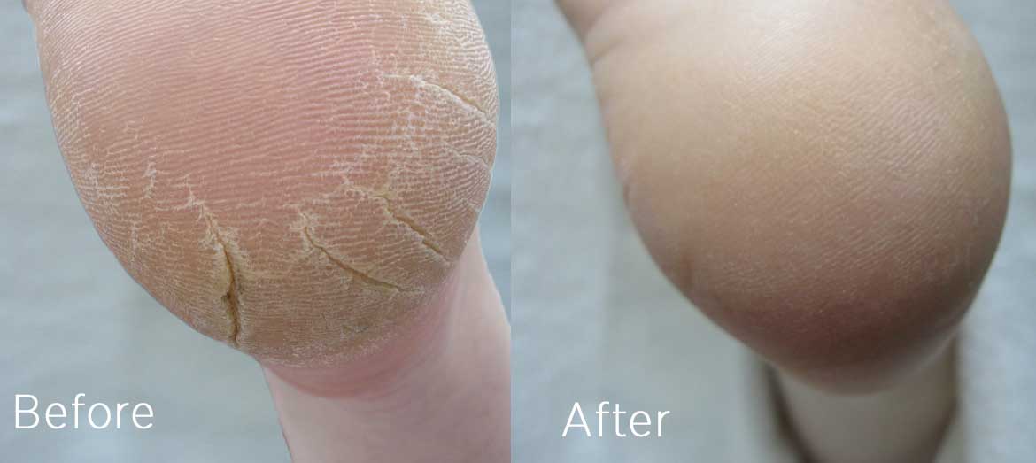Footlogix before and after