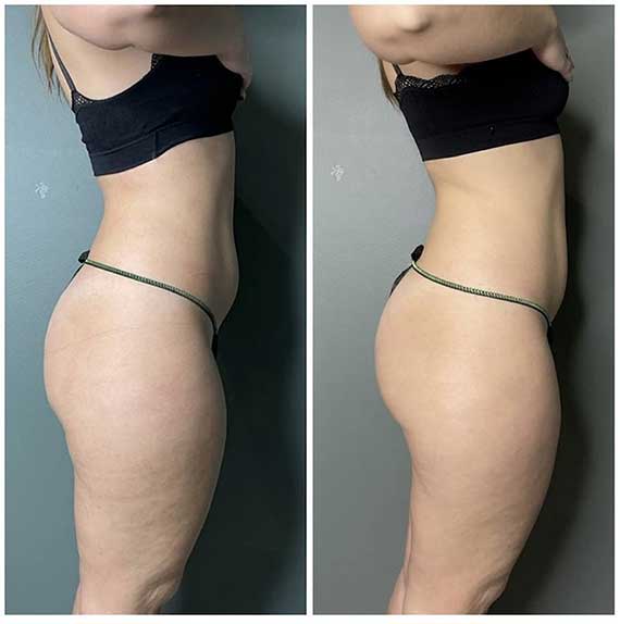 Guam Seaweed Body Wrap Before and After Queen B Croydon